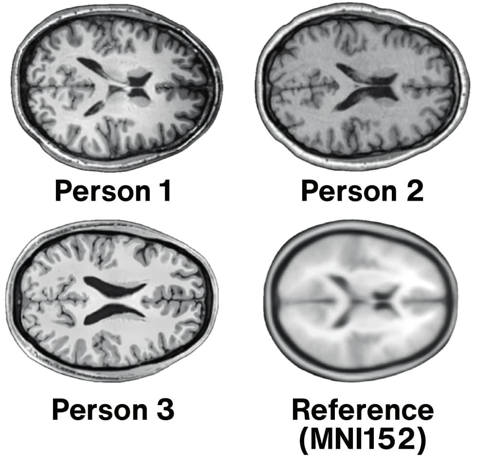 Four brain MRI slices seen from above. Person 1, Person 2 and Person 3 each have a different shape and fold pattern. The blurred, symmetric slice labeled Reference (MNI152) is the averaged brain that scans are warped to match.